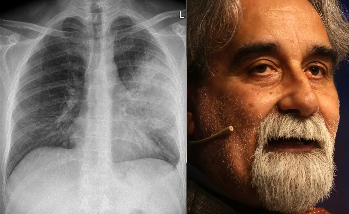 Radiografia polmonare che mostra polmonite interstiziale