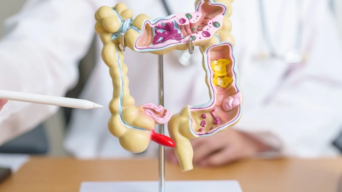 Rappresentazione del tumore al colon